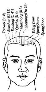 zhu's scalp acupuncture